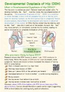 Developmental Dysplasia of Hip